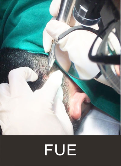 毛囊單位切割術（FUE)