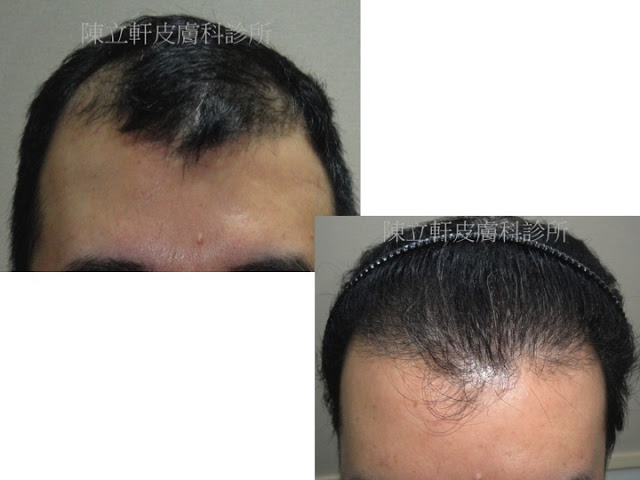寶寶頭上禿，寶寶不說之一(雄性禿第二期及植髮恢復過程,FUT,1000株)