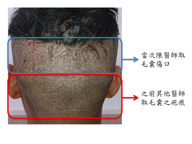 FUE的品質怎麼看