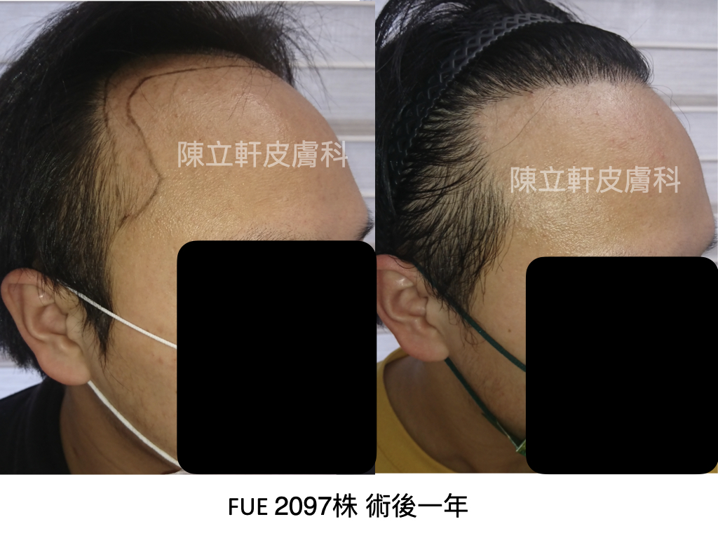 案例分享-談顳側髮際線(第三期雄性禿，FUE，2097株)