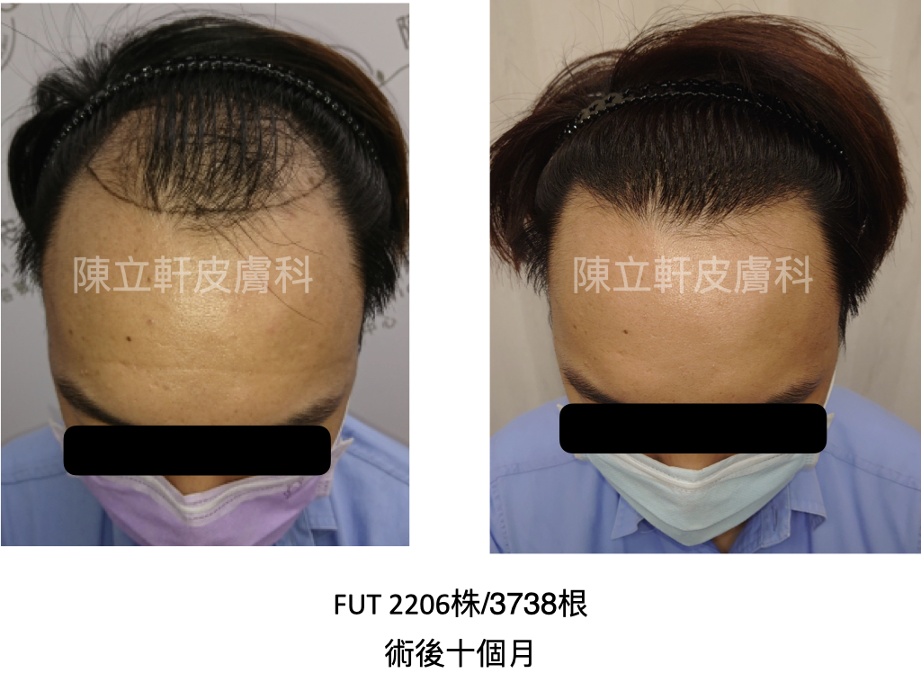 困難髮際線案例（第三期雄性禿，FUT，2206株/3738根）
